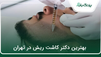بهترین دکتر کاشت ریش در تهران