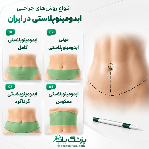 انواع روشهای جراحی ابدومینوپلاستی در ایران