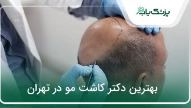 بهترین دکتر کاشت مو در تهران