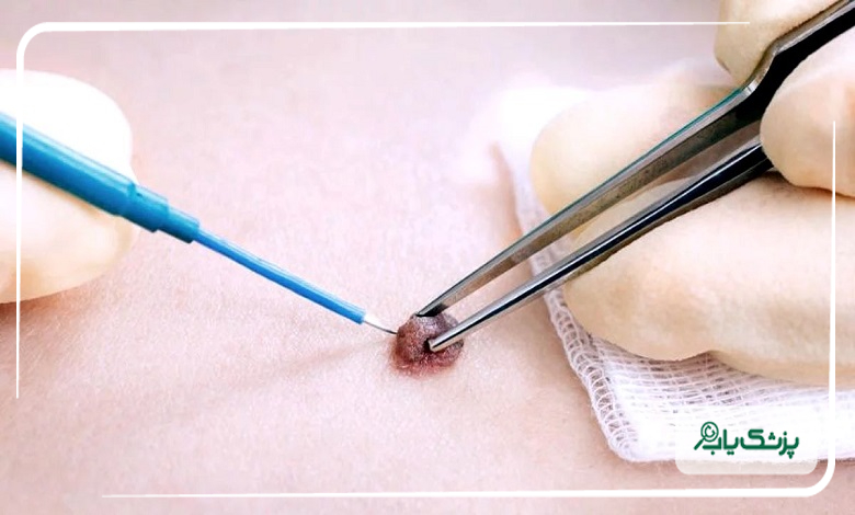 هزینه درمان زگیل تناسلی توسط دکتر زگیل تناسلی در غرب تهران