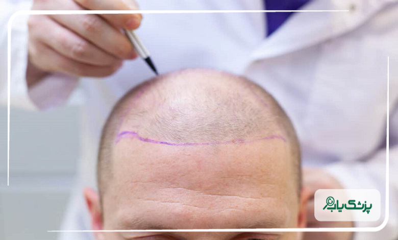 خدمات حرفهای بهترین دکتر کاشت مو در تبریز