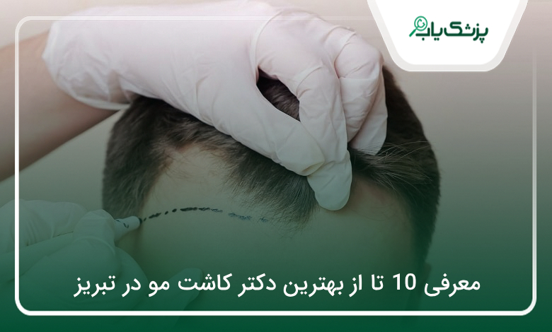 بهترین دکتر کاشت مو در تبریز