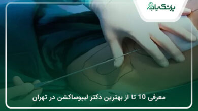 بهترین دکتر لیپوساکشن در تهران