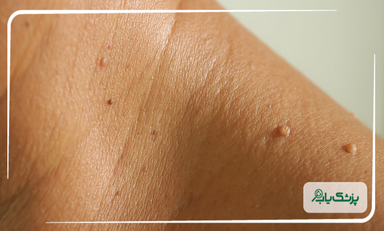 هزینه خدمات بهترین دکتر زگیل تناسلی در پاسداران