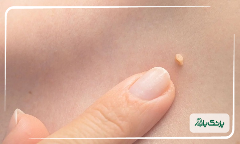 هزینه خدمات بهترین متخصص زگیل تناسلی در شهرک گلستان