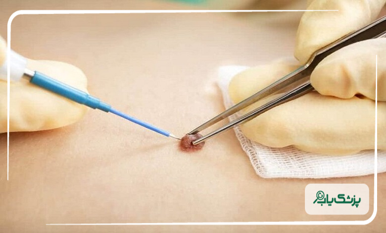 هزینه خدمات بهترین متخصص زگیل تناسلی در جنت آباد