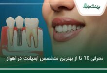 بهترین متخصص ایمپلنت در اهواز