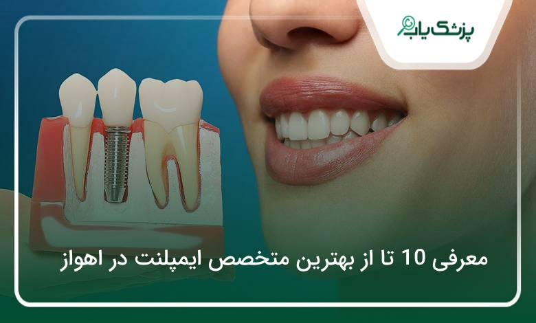بهترین متخصص ایمپلنت در اهواز