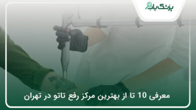 بهترین مرکز رفع تاتو در تهران