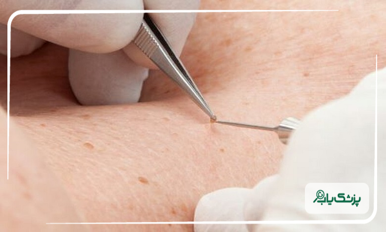 چگونگی درمان زگیل تناسلی