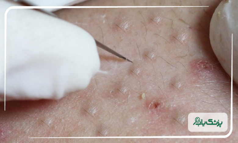 اقدامات بهترین متخصص زگیل تناسلی در اکباتان