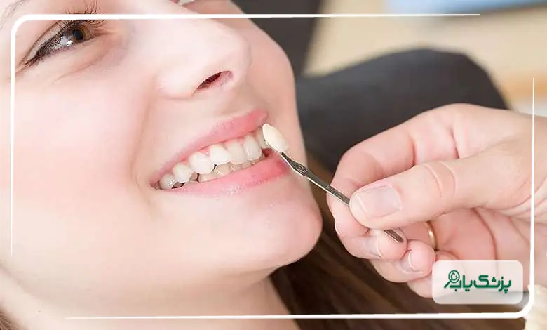 هزینه کامپوزیت دندان و عوامل موثر بر آن