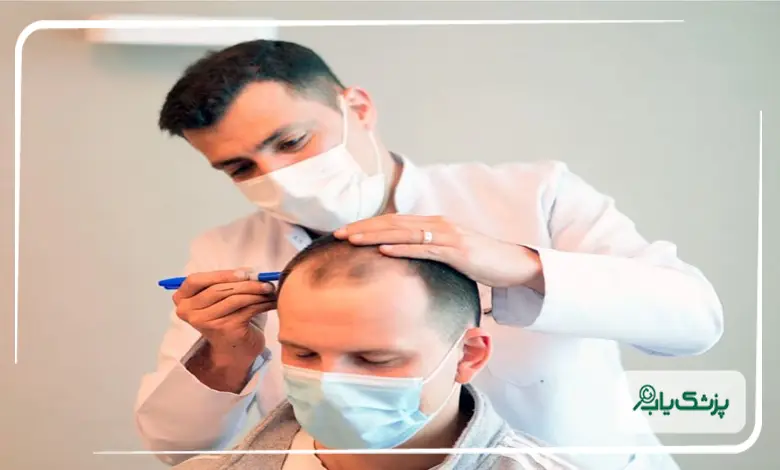 کاشت مو در چه سنی و در چه زمانی مناسبتر است؟