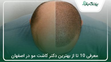 بهترین دکتر کاشت مو در اصفهان