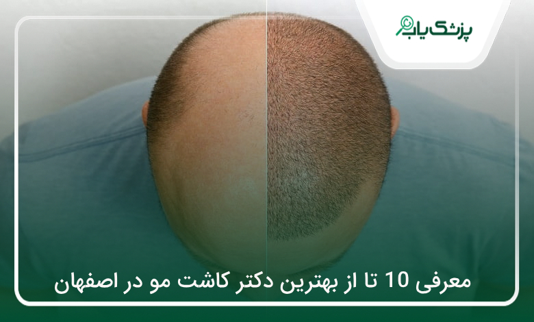 بهترین دکتر کاشت مو در اصفهان