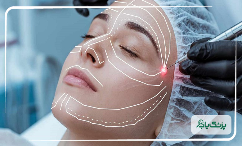 عوامل مؤثر بر دوام نتایج اندولیفت