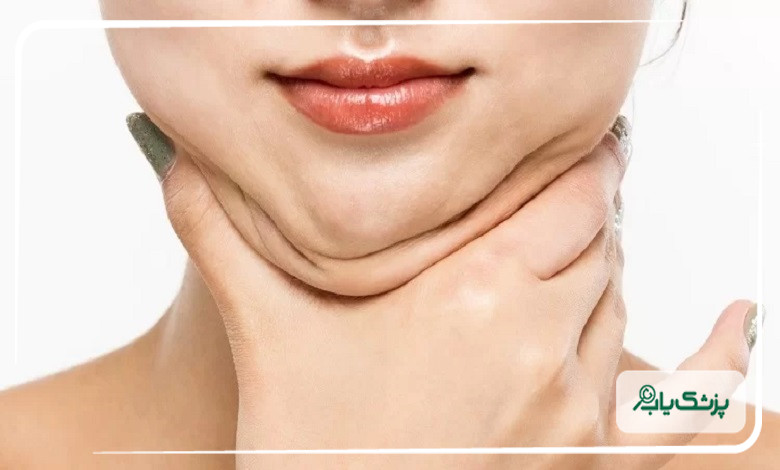 مراقبت بعد از درمان رفع غبغب و حفظ نتیجه