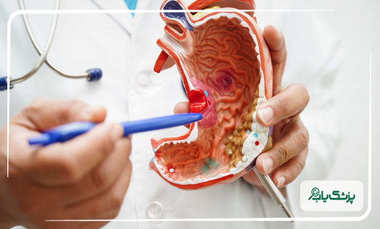 اسلیو معده و درمان دیابت نوع 2