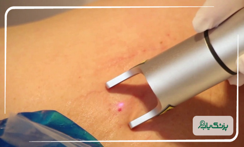 ویژگی های بهترین مرکز لیزر زگیل تناسلی