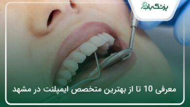 بهترین متخصص ایمپلنت در مشهد
