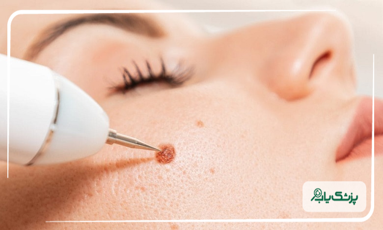 برداشتن خال با لیزر برای چه افرادی مناسب است؟