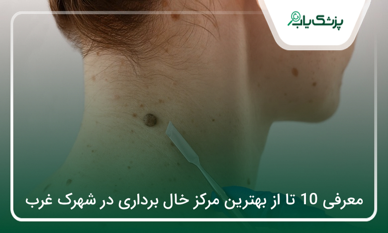 بهترین مرکز خال برداری در شهرک غرب