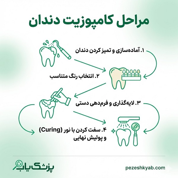 مراحل کامپوزیت دندان