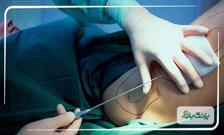 چگونه بهترین جراح اسلیو معده در اصفهان را انتخاب کنیم؟ نکات مهم
