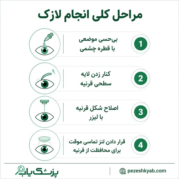 مراحل کلی انجام لازک