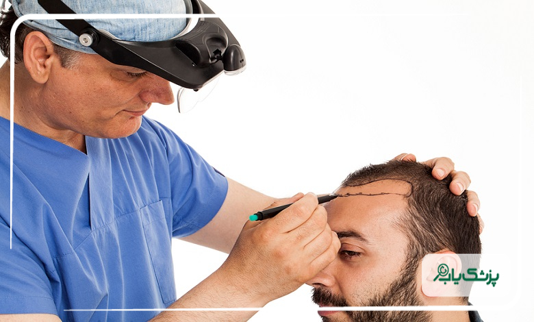 مهم ترین نکات در انتخاب دکتر کاشت مو
