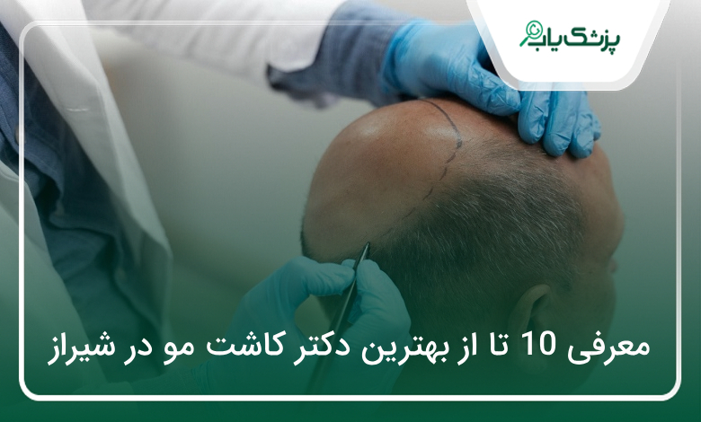 بهترین دکتر کاشت مو در شیراز