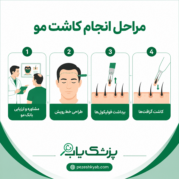 مراحل انجام کاشت مو