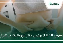 بهترین دکتر لیپوماتیک در شیراز