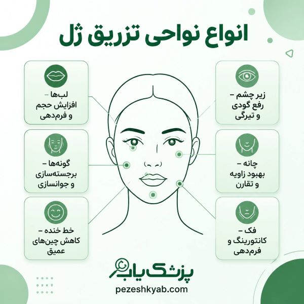 انواع نواحی تزریق ژل