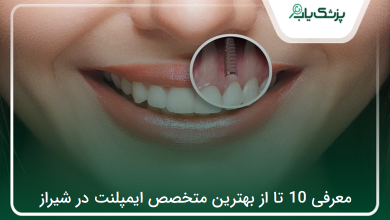 بهترین متخصص ایمپلنت در شیراز