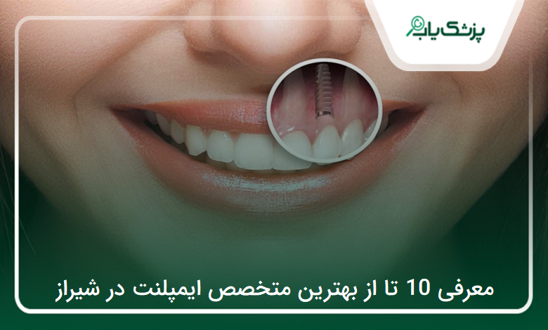بهترین متخصص ایمپلنت در شیراز