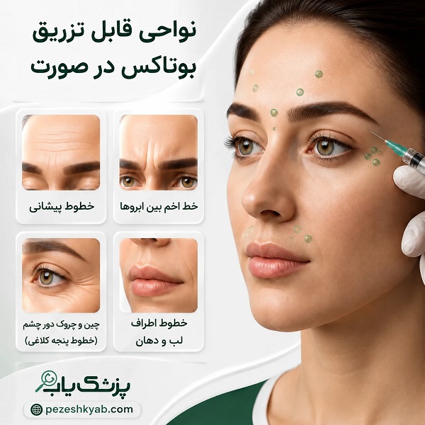 نواحی قابل تزریق بوتاکس در صورت