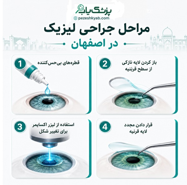 مراحل جراحی لیزیک در اصفهان