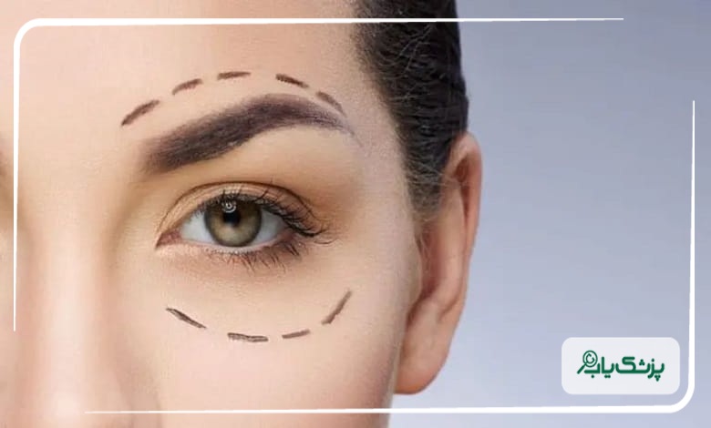 دوره نقاهت بلفاروپلاستی چند روز است؟