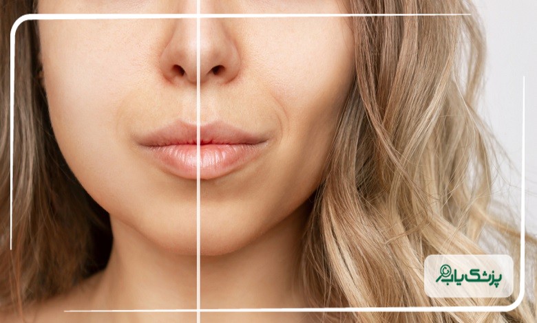 جراحی برداشتن بوکال فت و ایجاد زاویه فک در تبریز