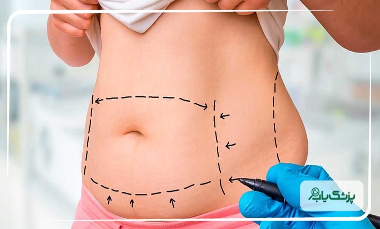 تفاوت لیپوماتیک با لیپوساکشن چیست؟