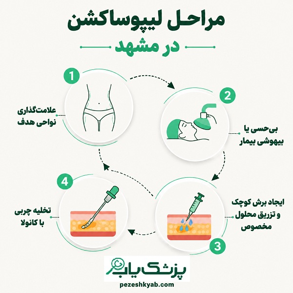 مراحل لیپوساکشن در مشهد