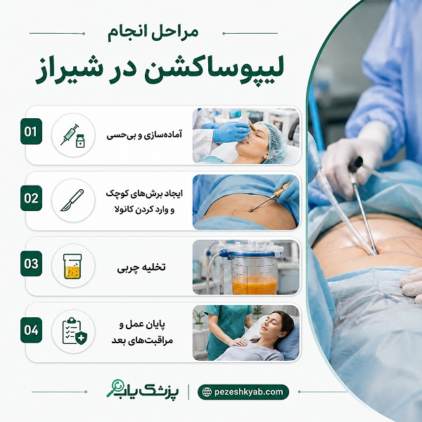 مراحل انجام لیپوساکشن در شیراز