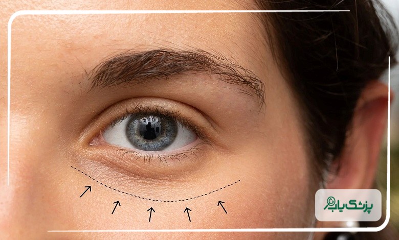 تزریق فیلر زیر چشم چگونه انجام می شود؟