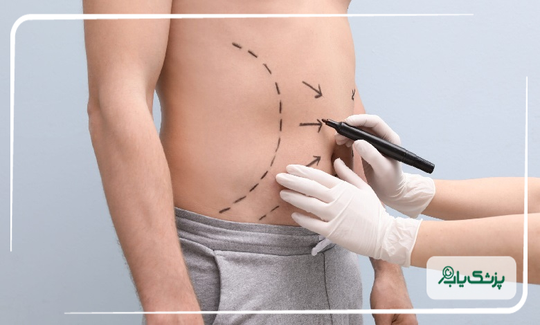 لیپوماتیک بهتر است یا لاغری با ورزش؟
