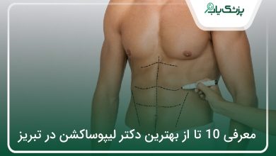 بهترین دکتر لیپوساکشن در تبریز