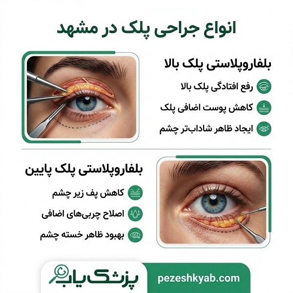 انواع جراحی پلک در مشهد