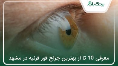 بهترین جراح قوز قرنیه در مشهد