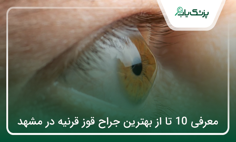 بهترین جراح قوز قرنیه در مشهد
