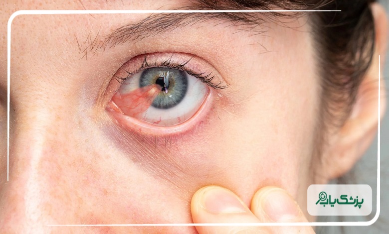 چه زمانی باید برای عمل ناخنک اقدام کنیم؟